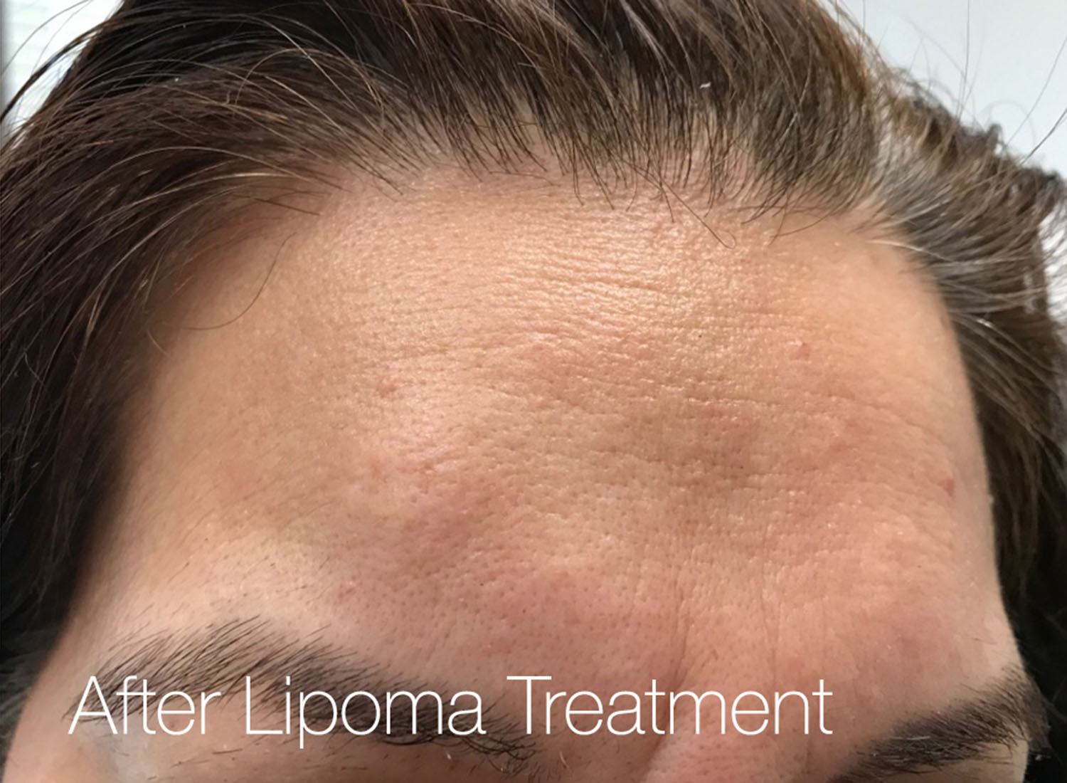 Lipoma After