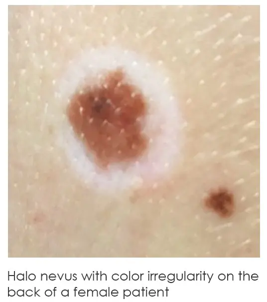 Halo nevus with color irregularity on the back of a female patient