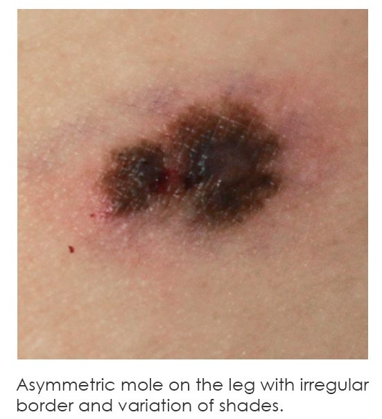 Asymmetric mole on the leg with irregular border and variation of shades