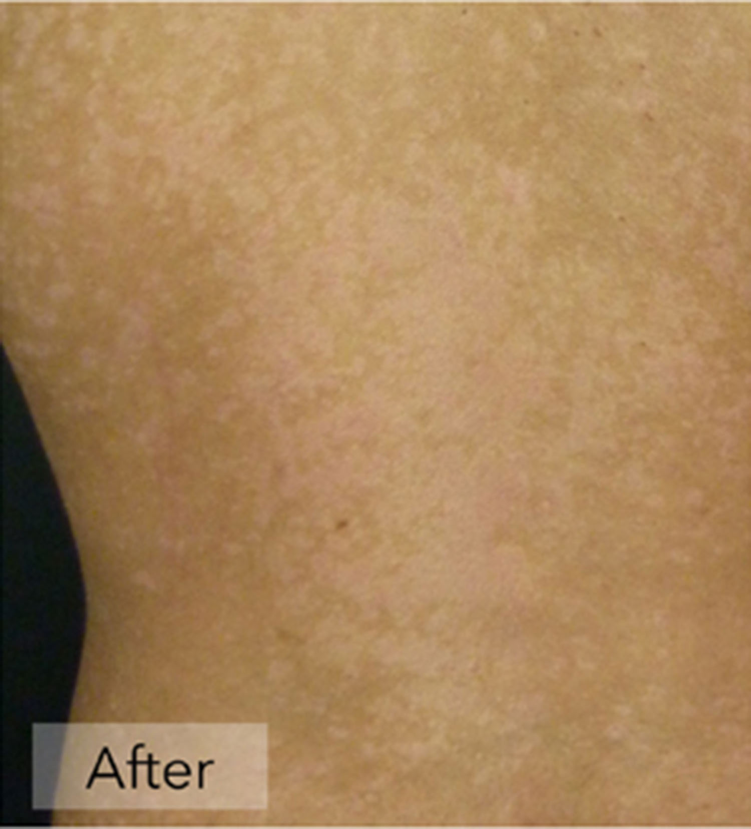 Psoriasis After