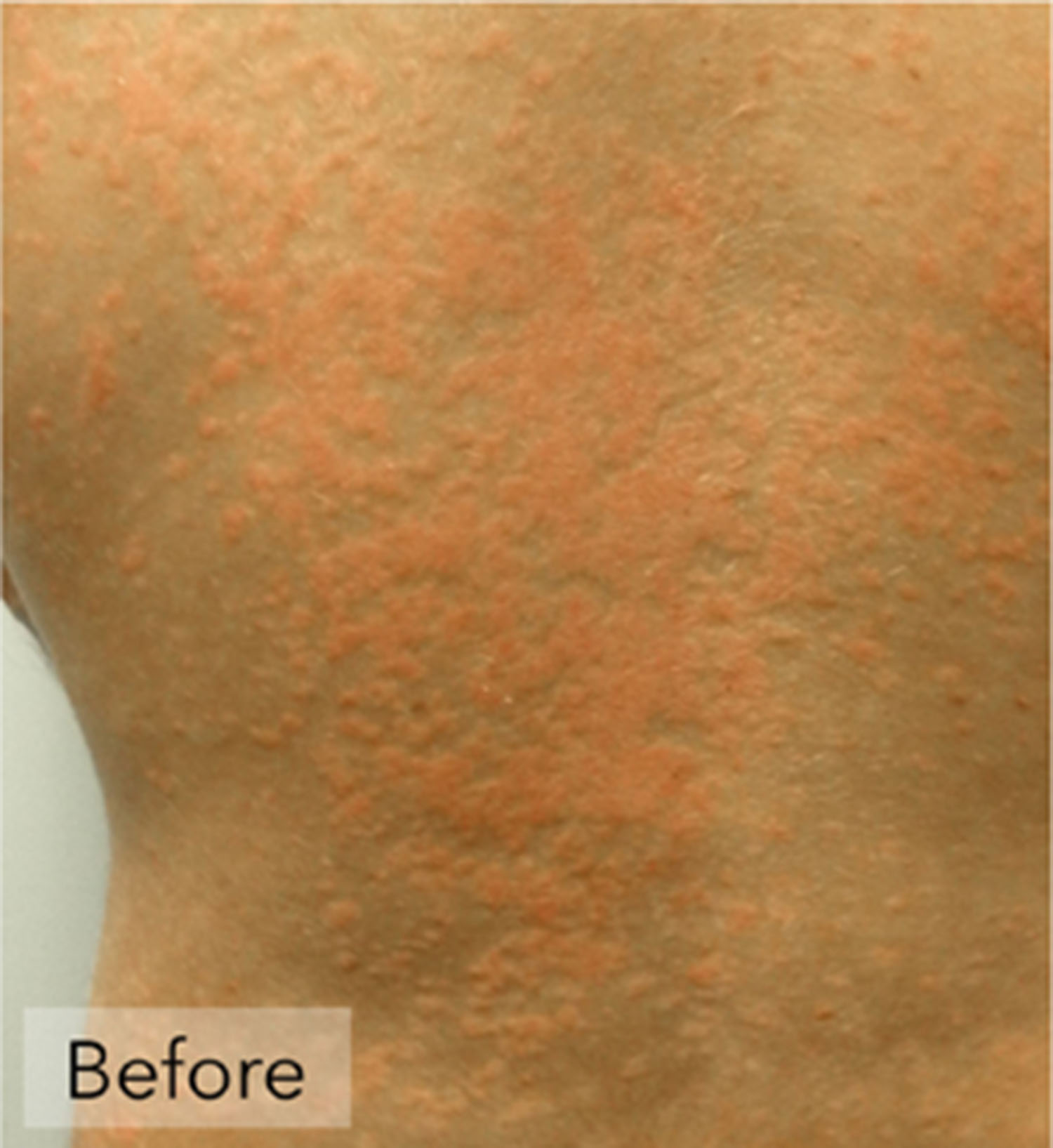 Psoriasis Before