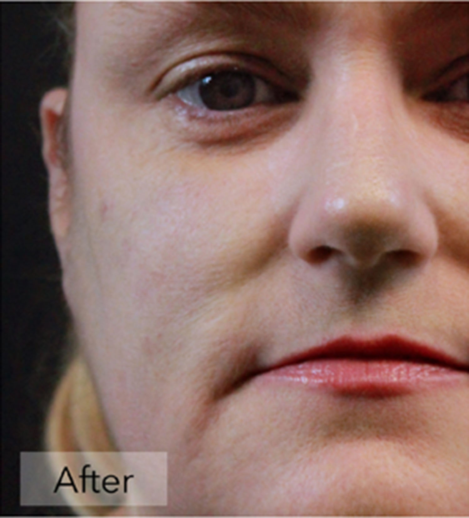 Rosacea After