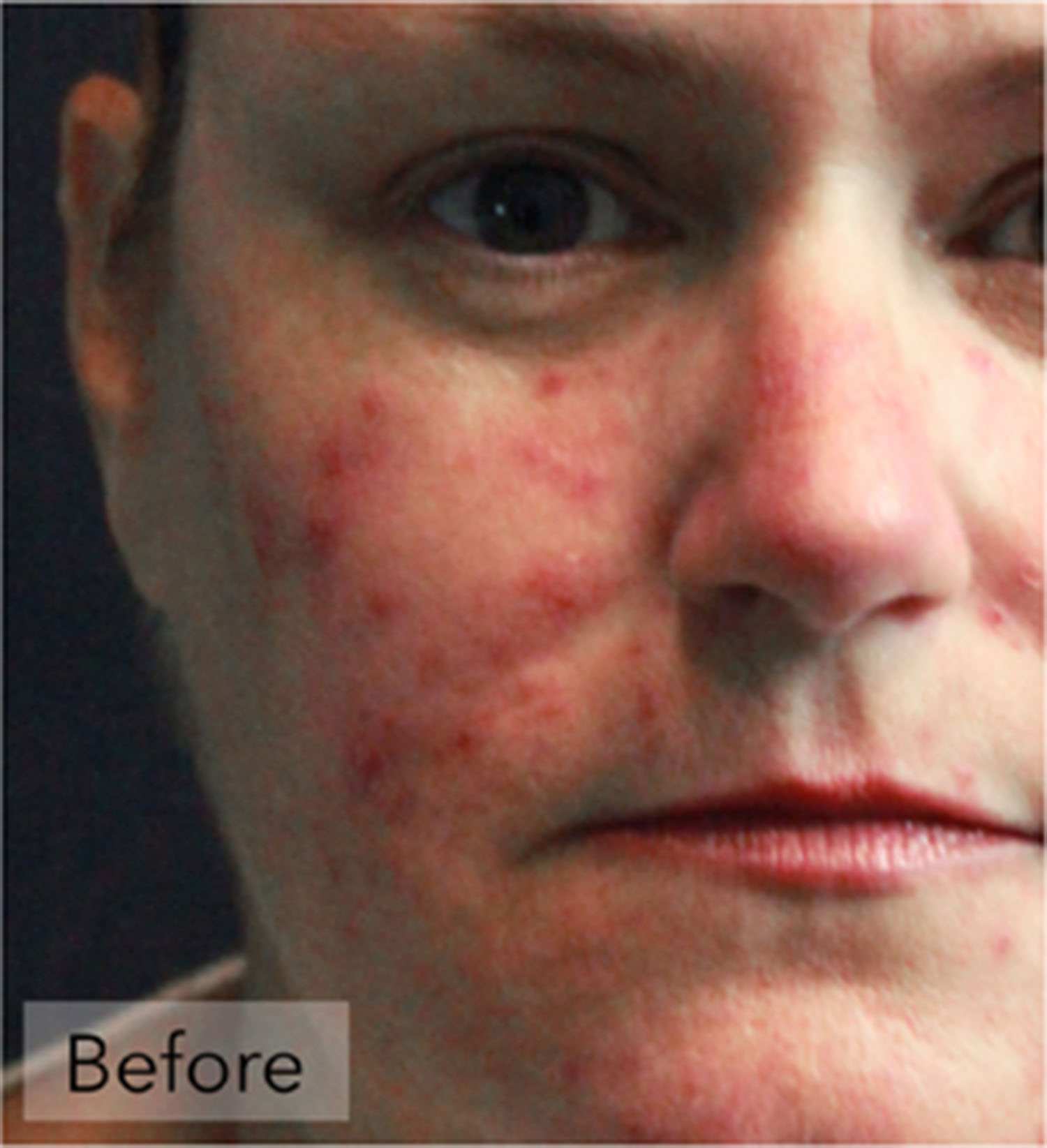 Rosacea Before