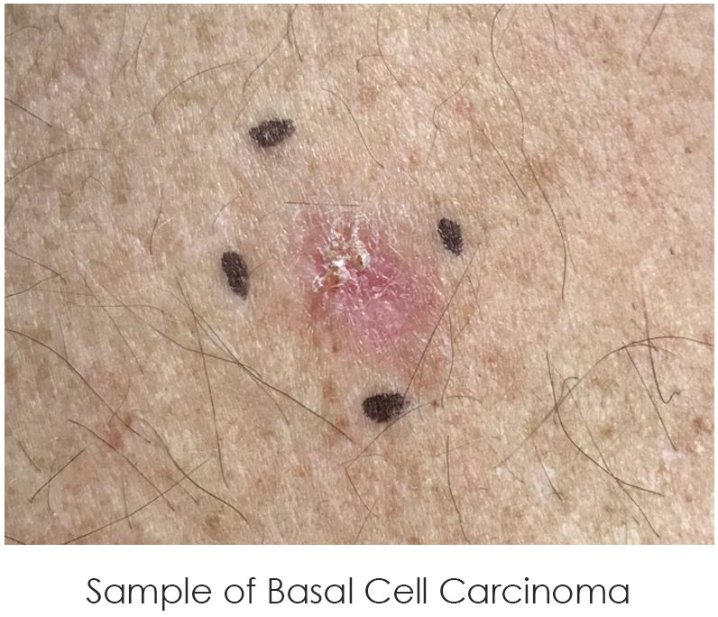 Sample of Basal Cell Carcinoma
