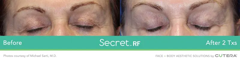 Secret-RF-10