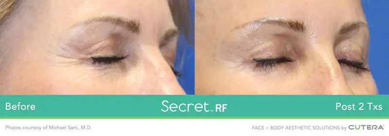 Secret-RF-11