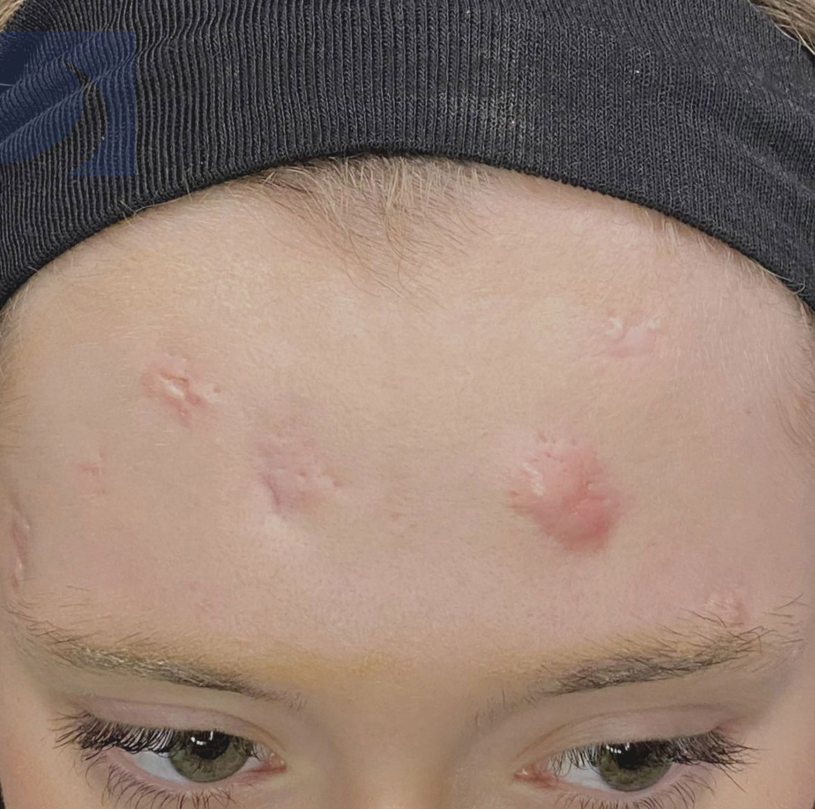 Zero Gravity patient's results at Dermatology Office in Dallas, TX by Dr. Ellen Turner.
