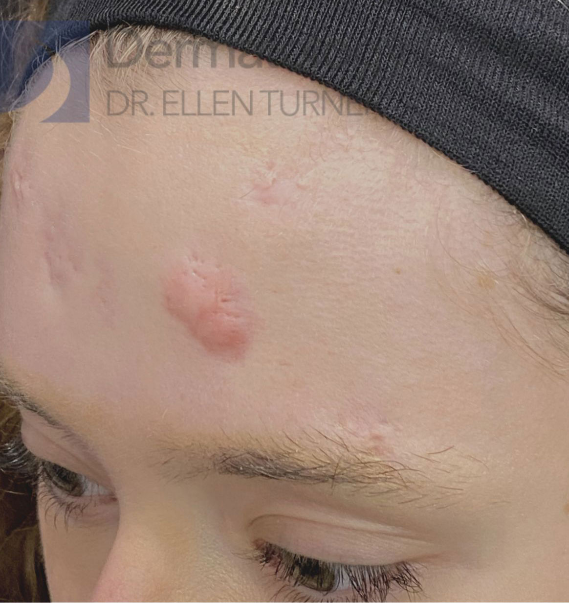 Zero Gravity patient's results at Dermatology Office in Dallas, TX by Dr. Ellen Turner.