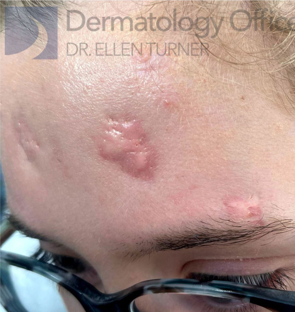Zero Gravity patient's results at Dermatology Office in Dallas, TX by Dr. Ellen Turner.