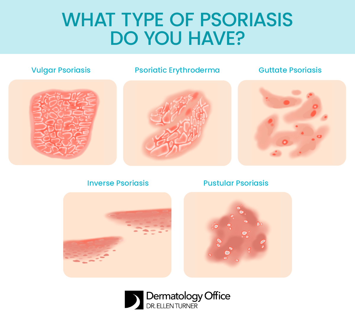 Learn about different types of psoriasis at the Dallas and Irving-based Dermatology Office of Dr. Ellen Turner.