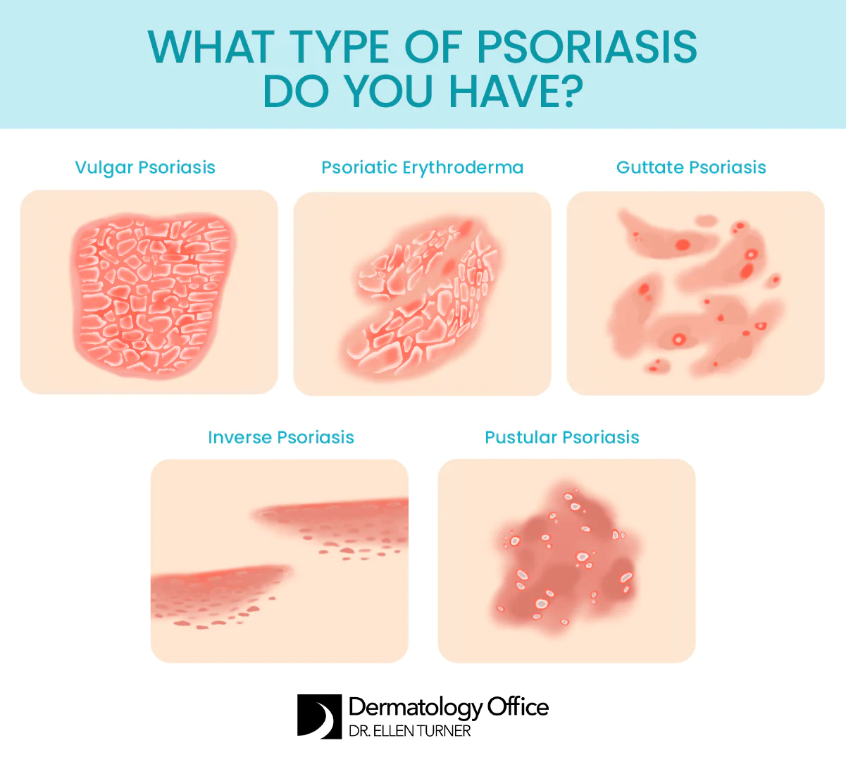 Learn about different types of psoriasis at the Dallas and Irving-based Dermatology Office of Dr. Ellen Turner.