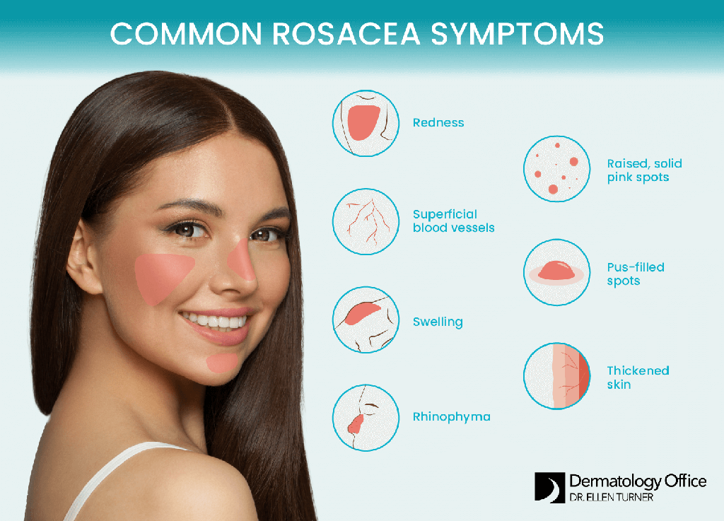 Learn the various symptoms of rosacea from Dallas and Irving’s Dermatology Office.