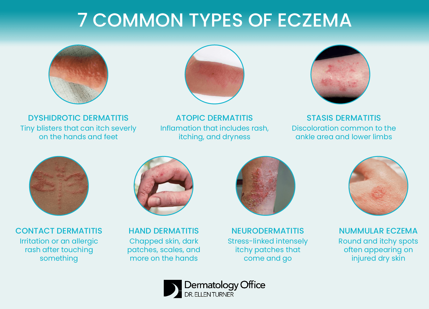 Learn about seven types of eczema from the Dallas area’s Dermatology Office.