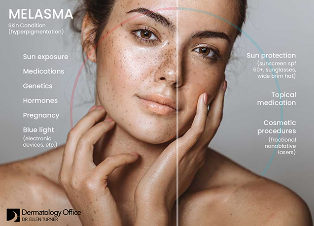 Learn about melasma from the Dallas and Irving-based team at the Dermatology Office.