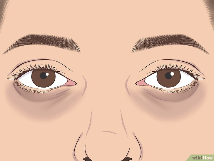 Types-of-Dark-Circles