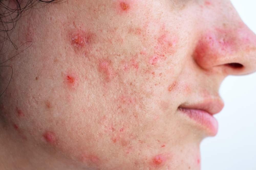 acne