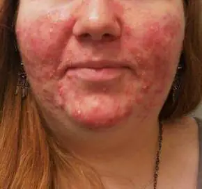 Acne treatment Dallas before result