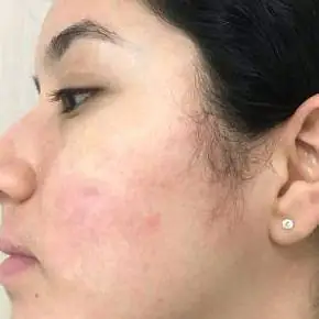 Acne treatment Dallas after result