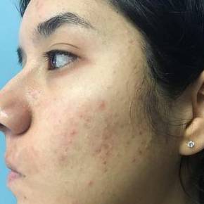 Acne treatment Dallas before result