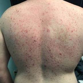 Acne treatment Dallas before result