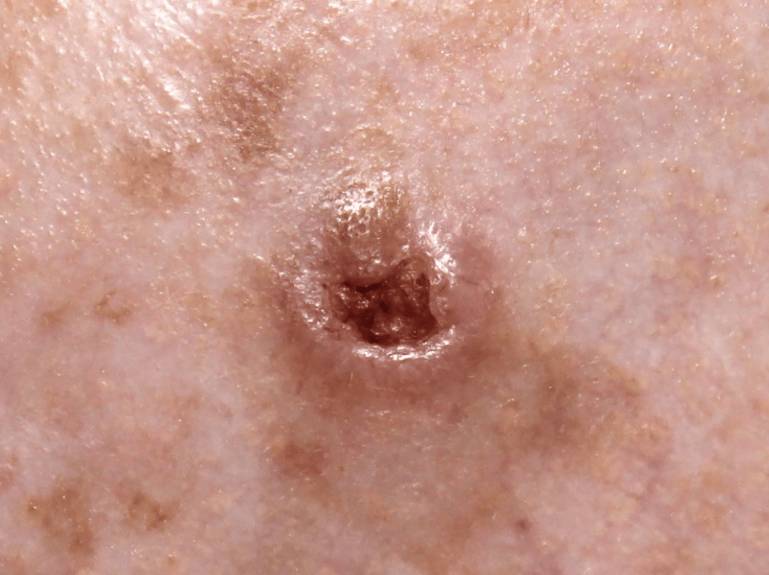 Full body skin exam by a board-certified dermatologist
