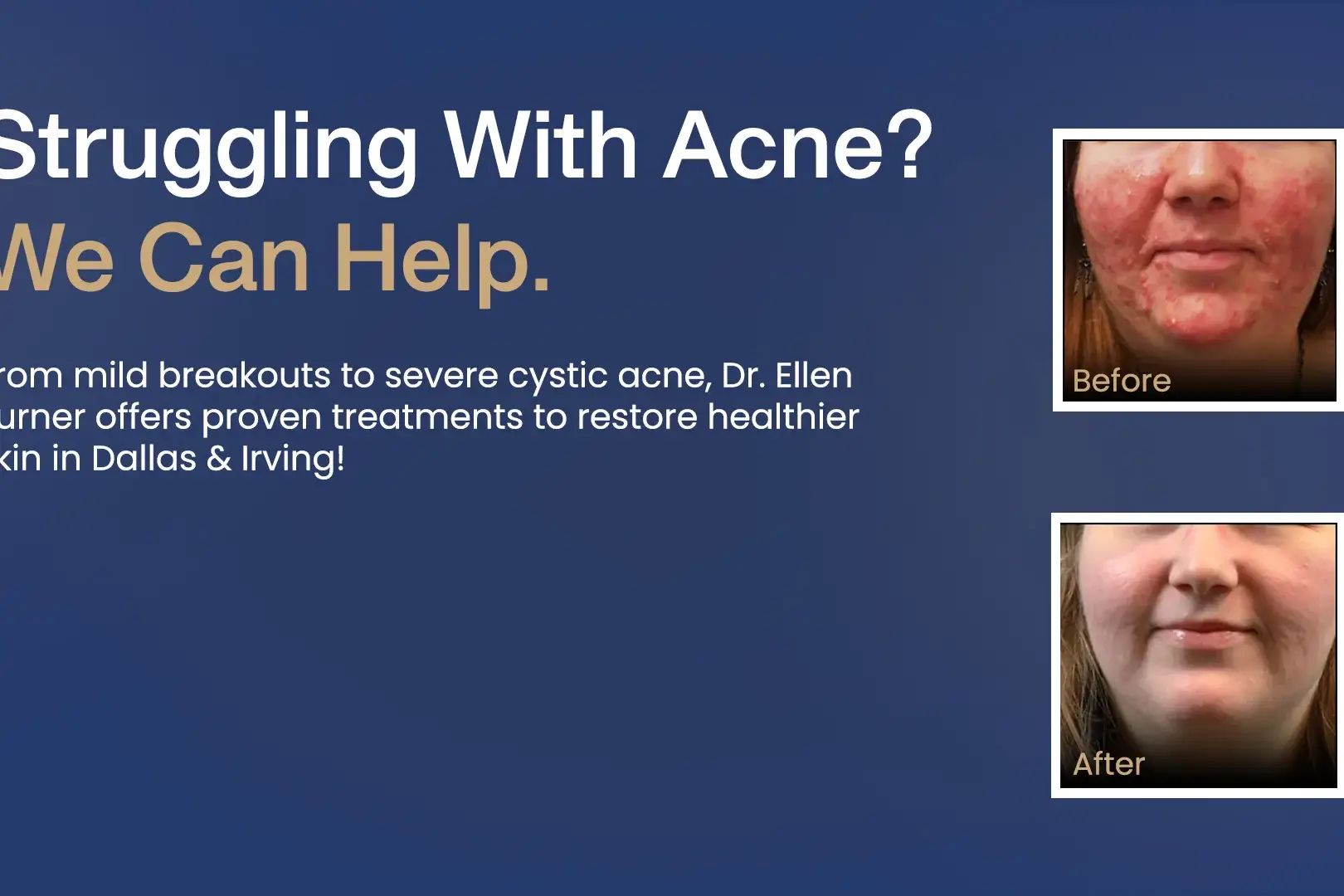 acne-page-hero-image