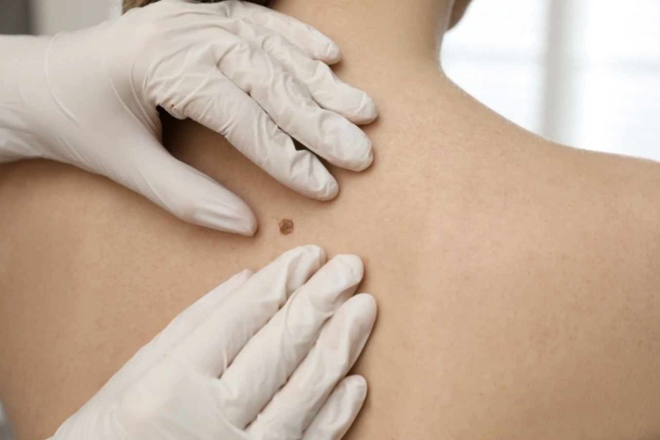 Book your skin cancer screening with Dr. Ellen Turner in Dallas