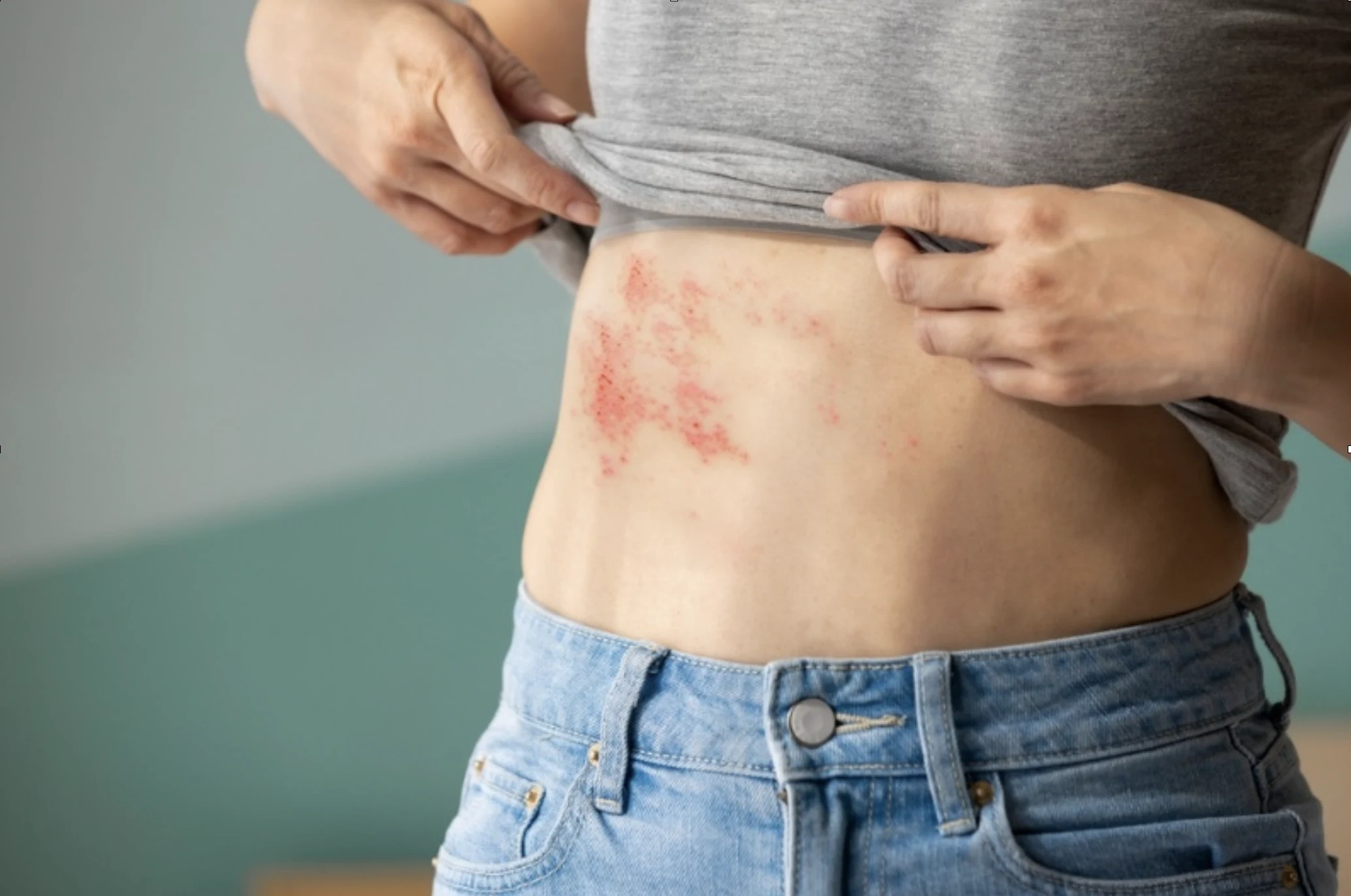 What is a skin rash