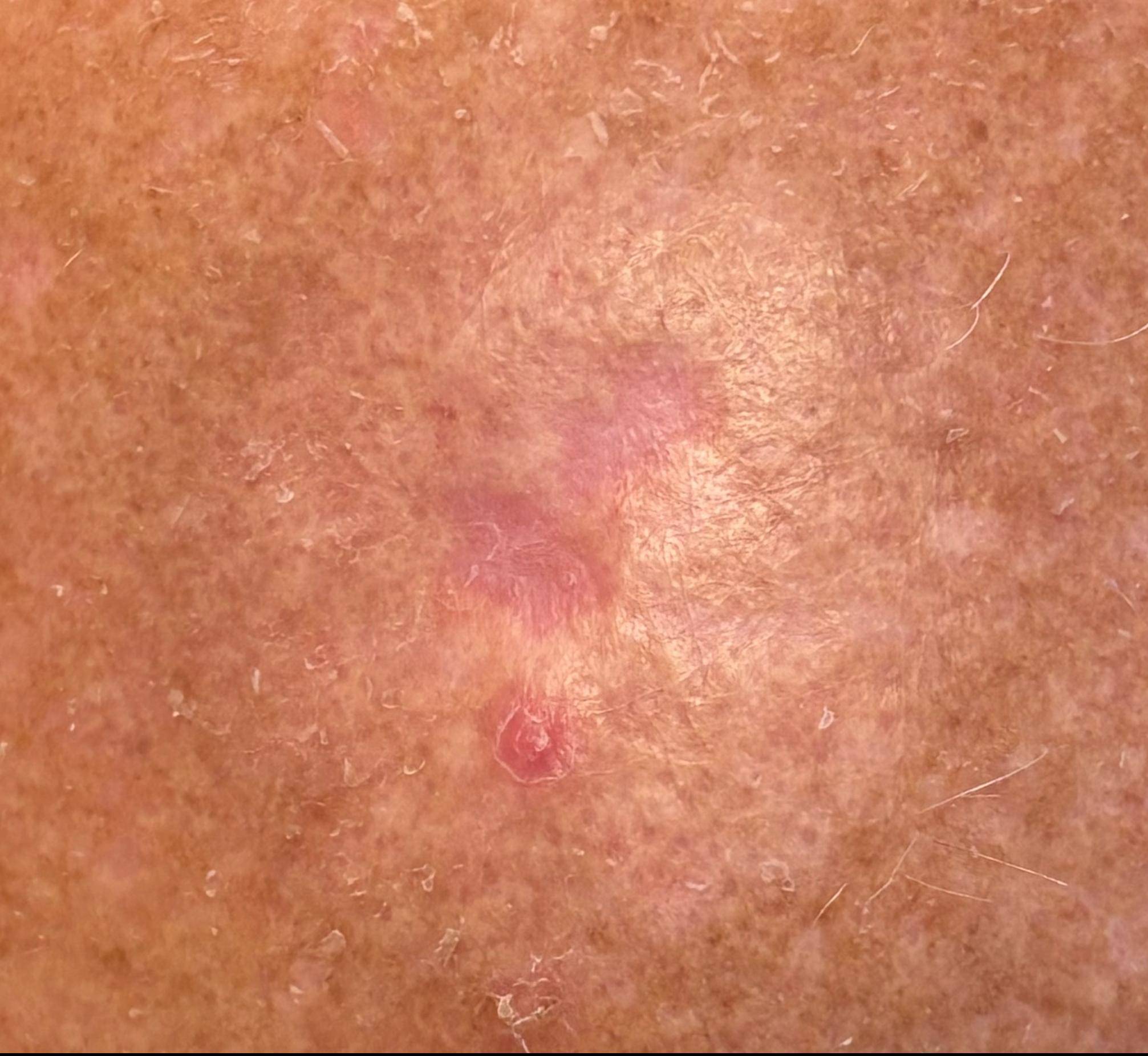 Melanoma In Situ after SRT-100 treatment Dallas