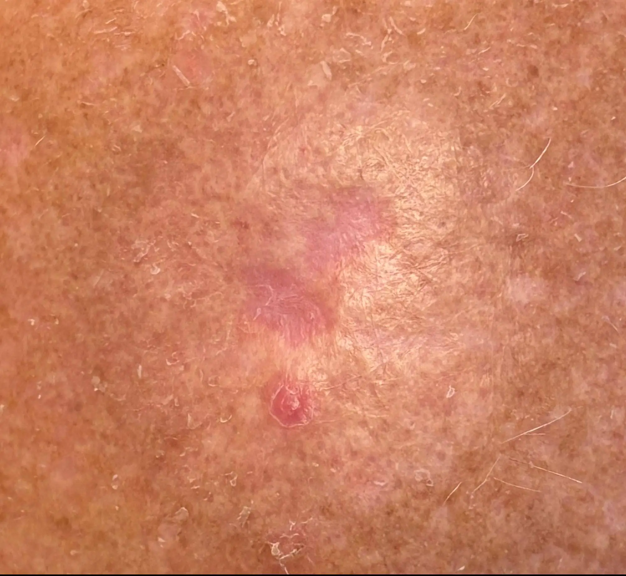 Melanoma In Situ after SRT-100 treatment Dallas