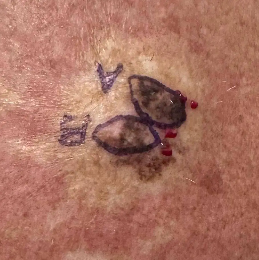 Melanoma In Situ before SRT-100 treatment Dallas