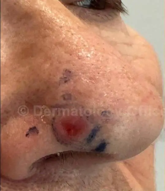 SRT-100 Skin Cancer Treatment Dallas before result