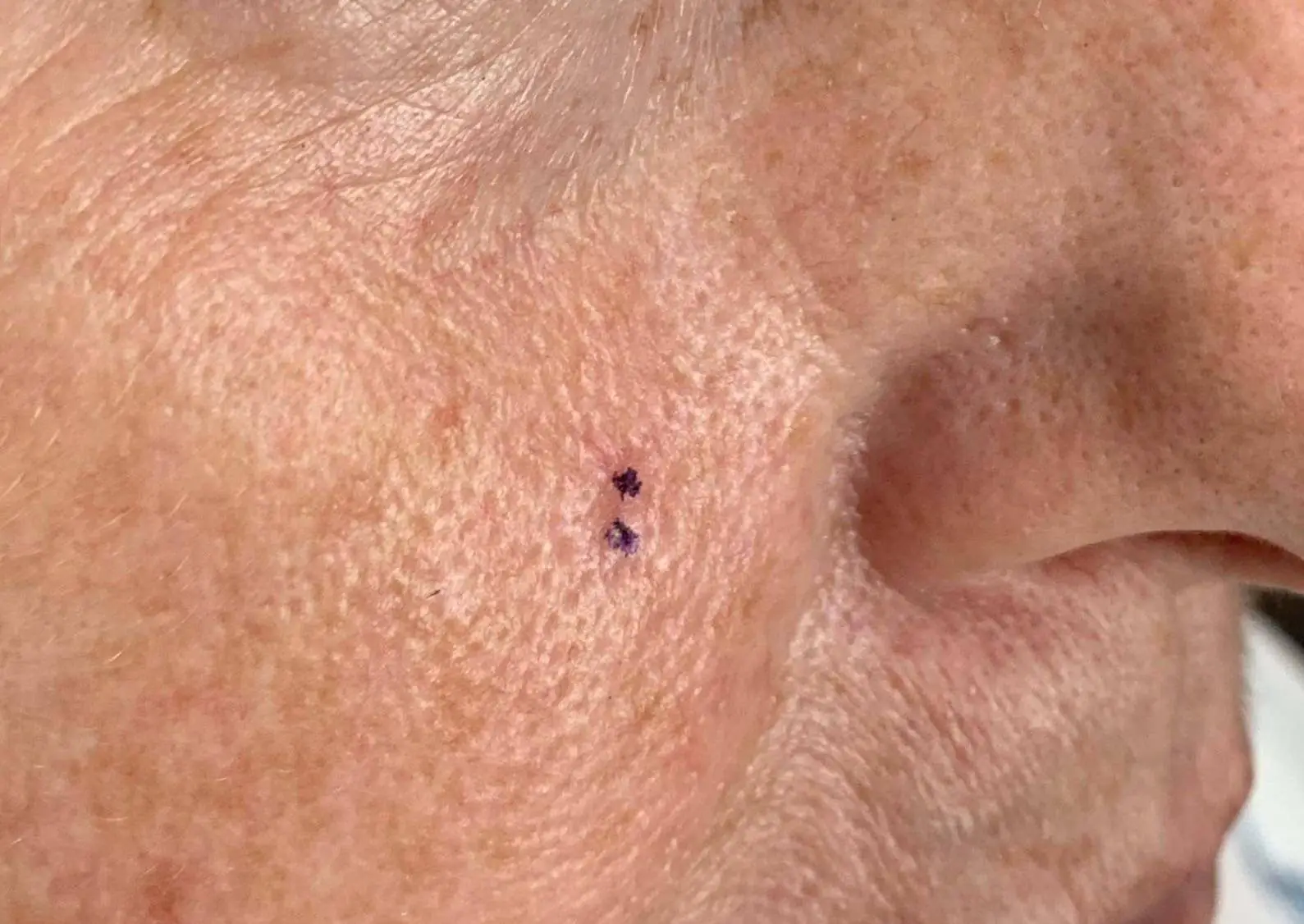 SRT-100 Skin Cancer Treatment Dallas before result