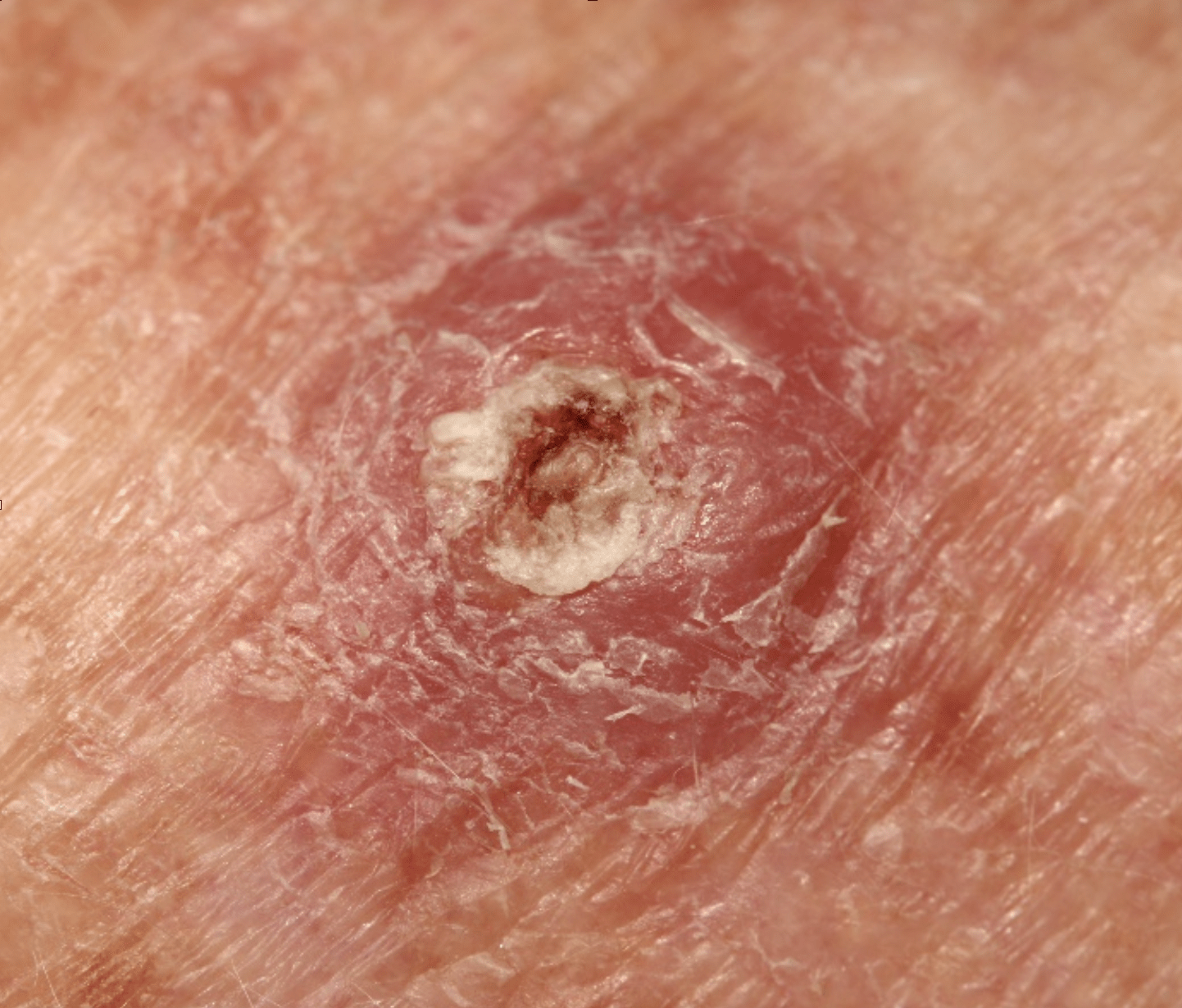 Warning signs of squamous cell carcinoma