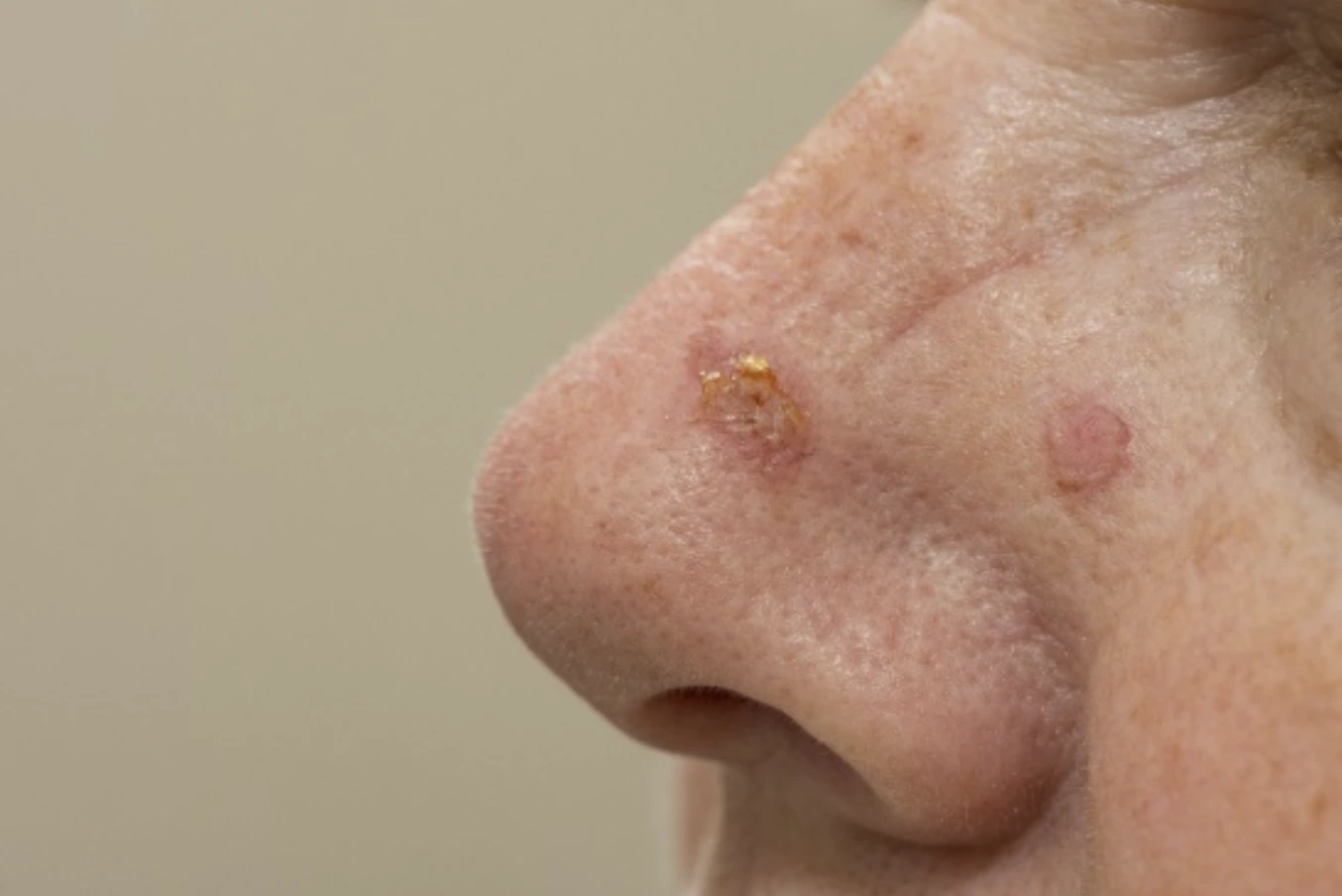 Why early detection of squamous cell carcinoma matters