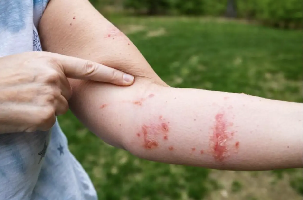Poison ivy rash on arm