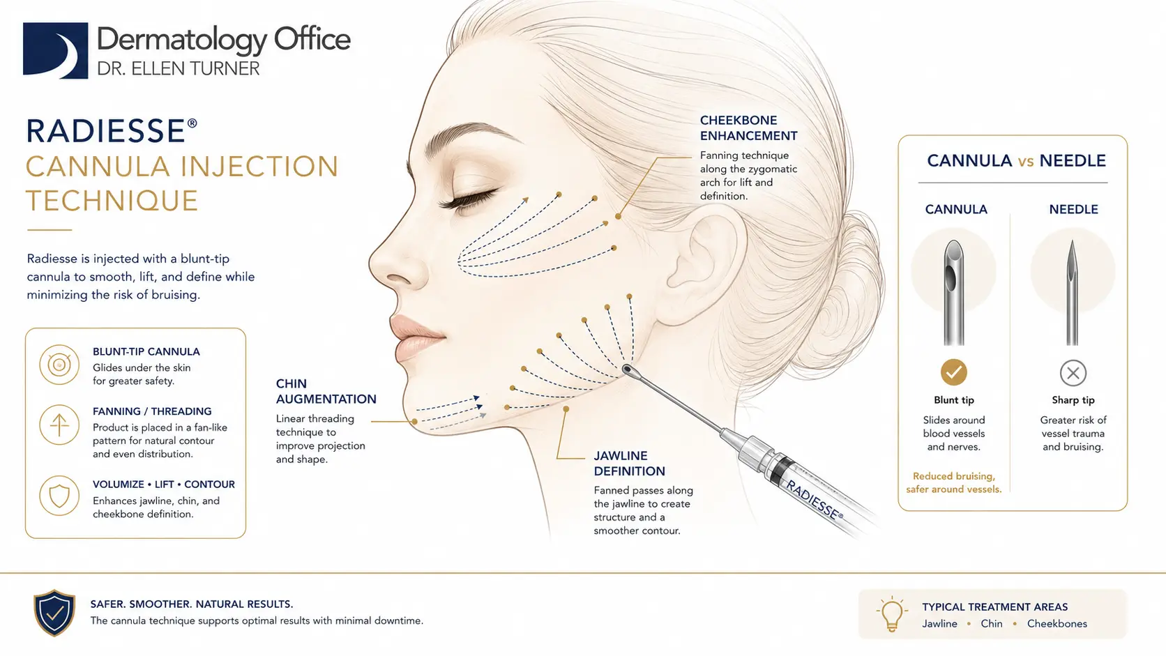 Radiesse cannula injection technique at Dermatology Office of Dr. Ellen Turner