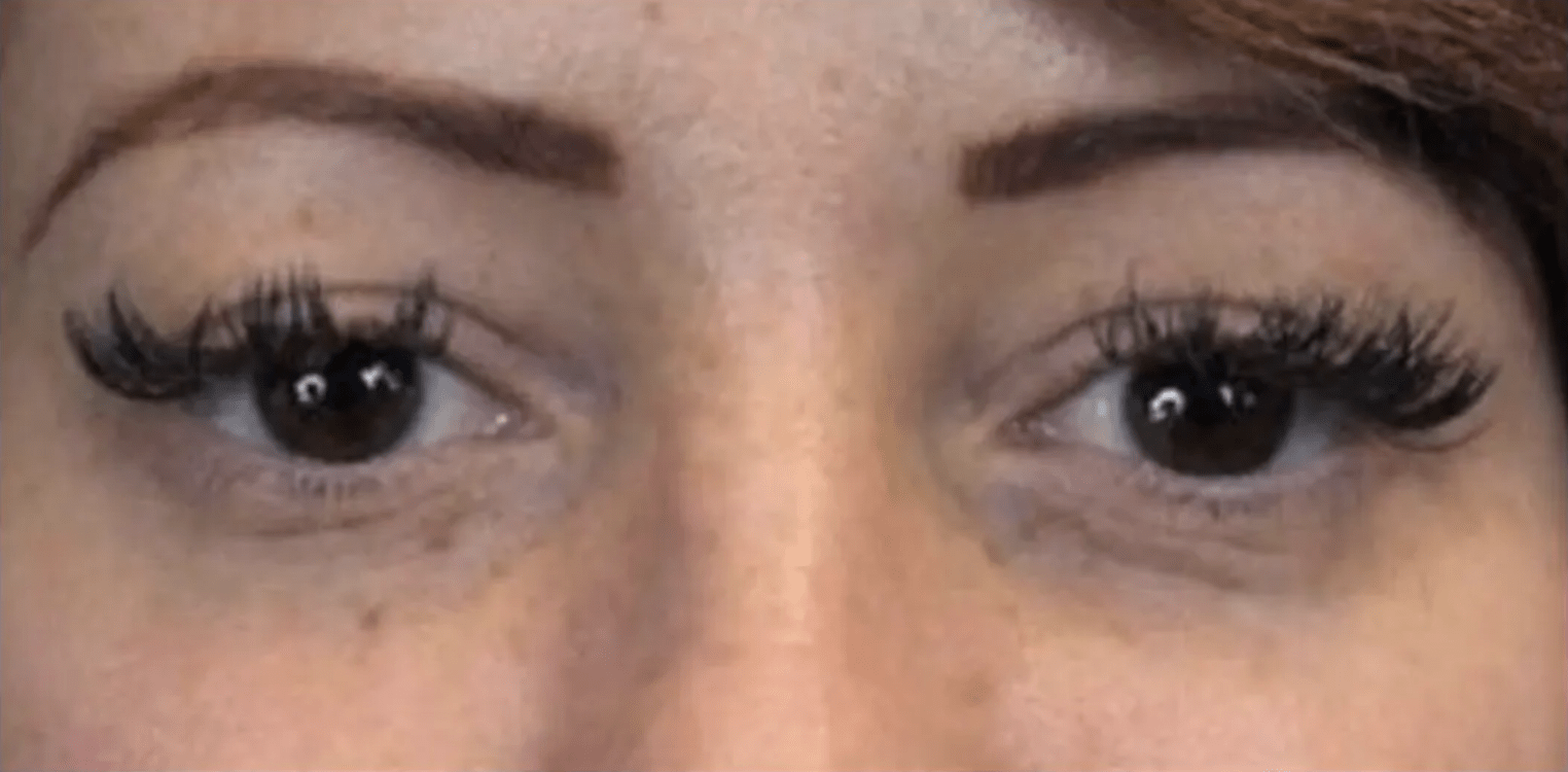 Restylane Eyelight under-eye filler before treatment in Dallas