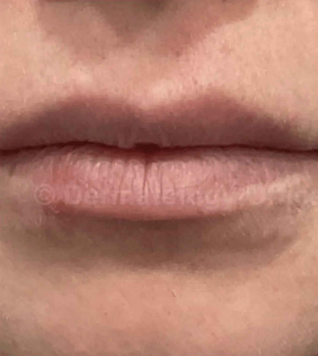 Restylane Kysse lip filler before treatment in Dallas