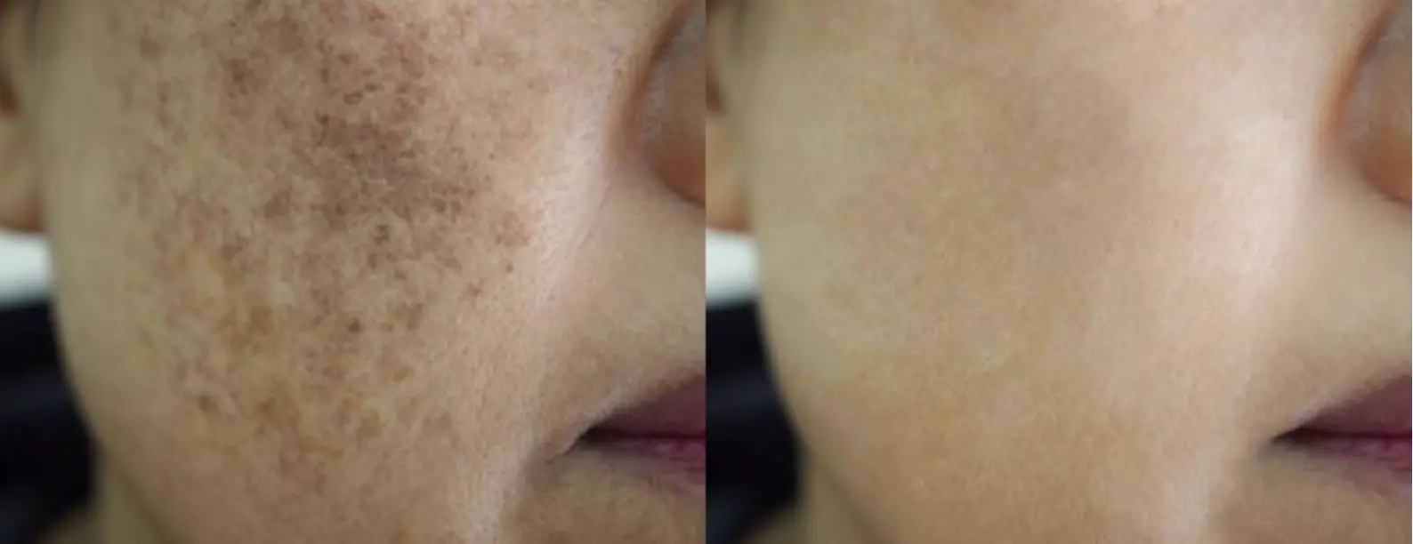 Melasma and pigmentation before and after treatment