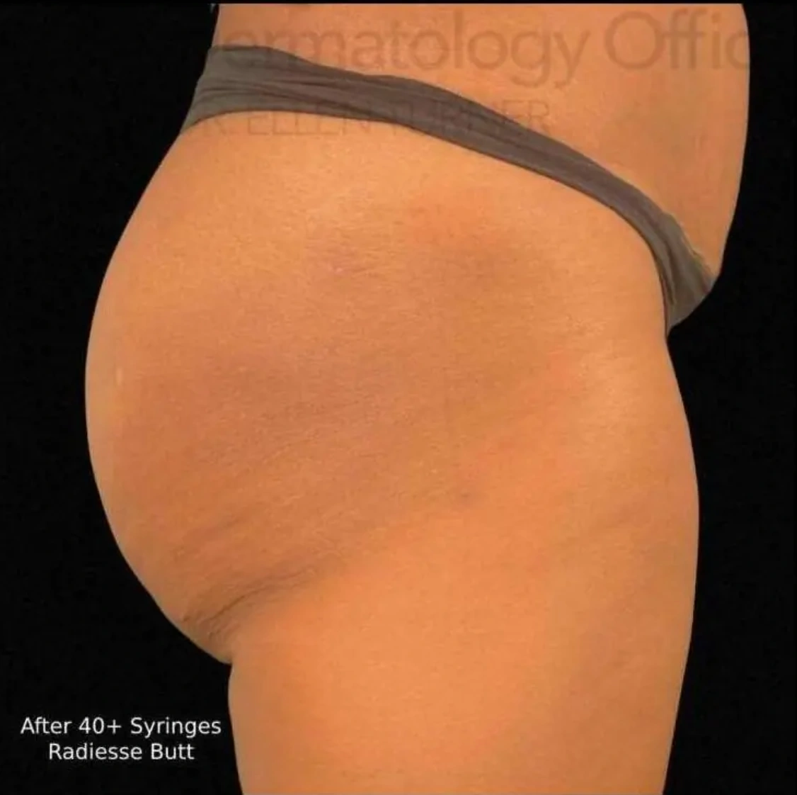 After Radiesse treatment