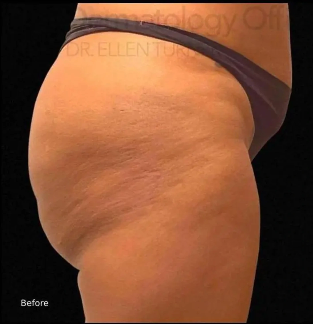 Before Radiesse treatment