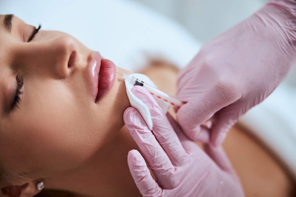 Restylane Kysse lip filler treatment at the Dermatology Office in Dallas
