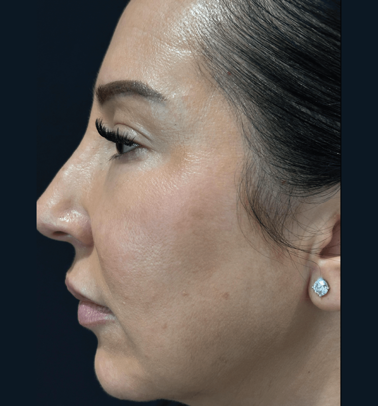 After Radiesse treatment