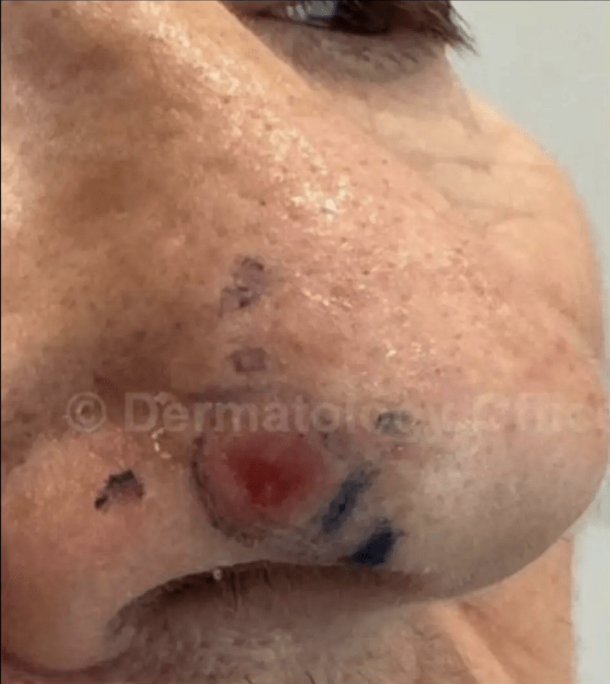 Before Superficial Radiation Therapy