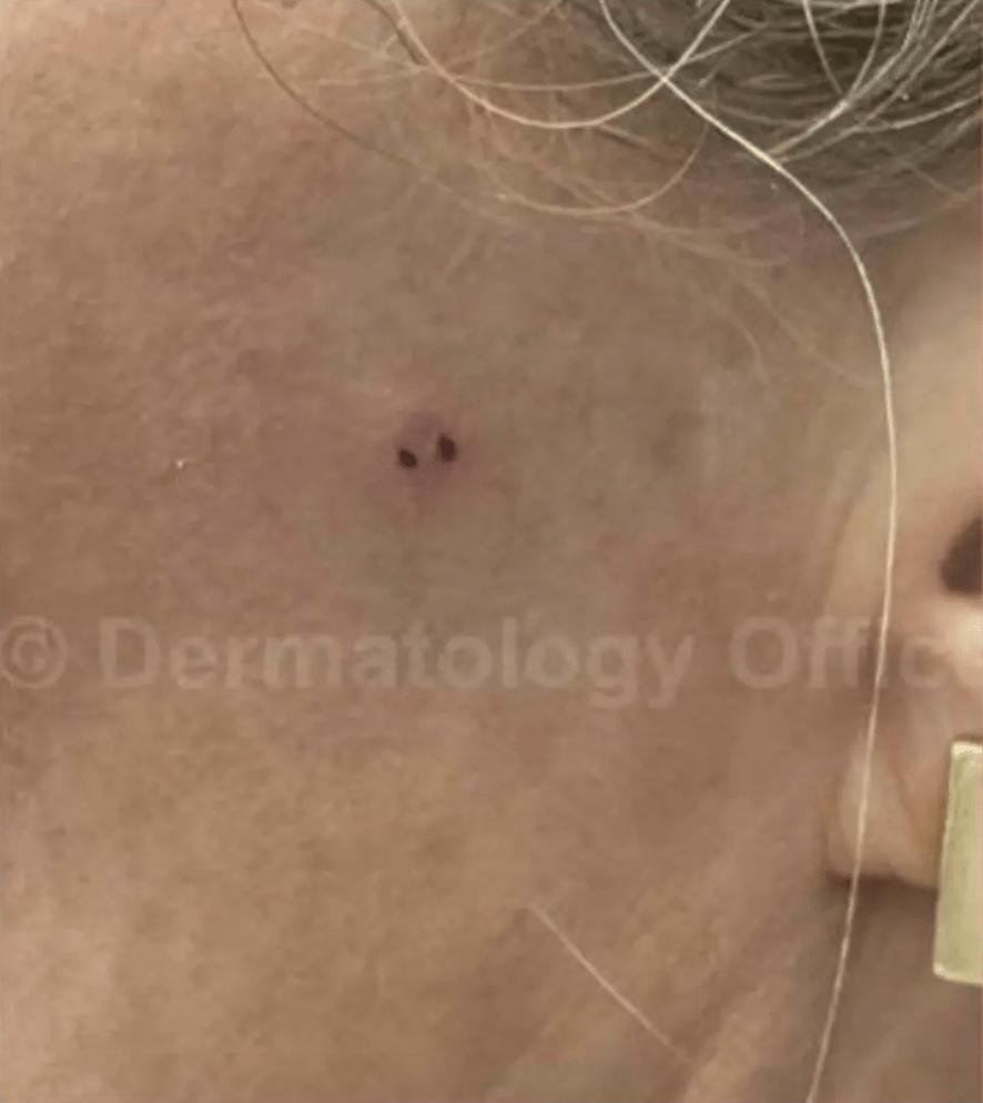 Before Superficial Radiation Therapy