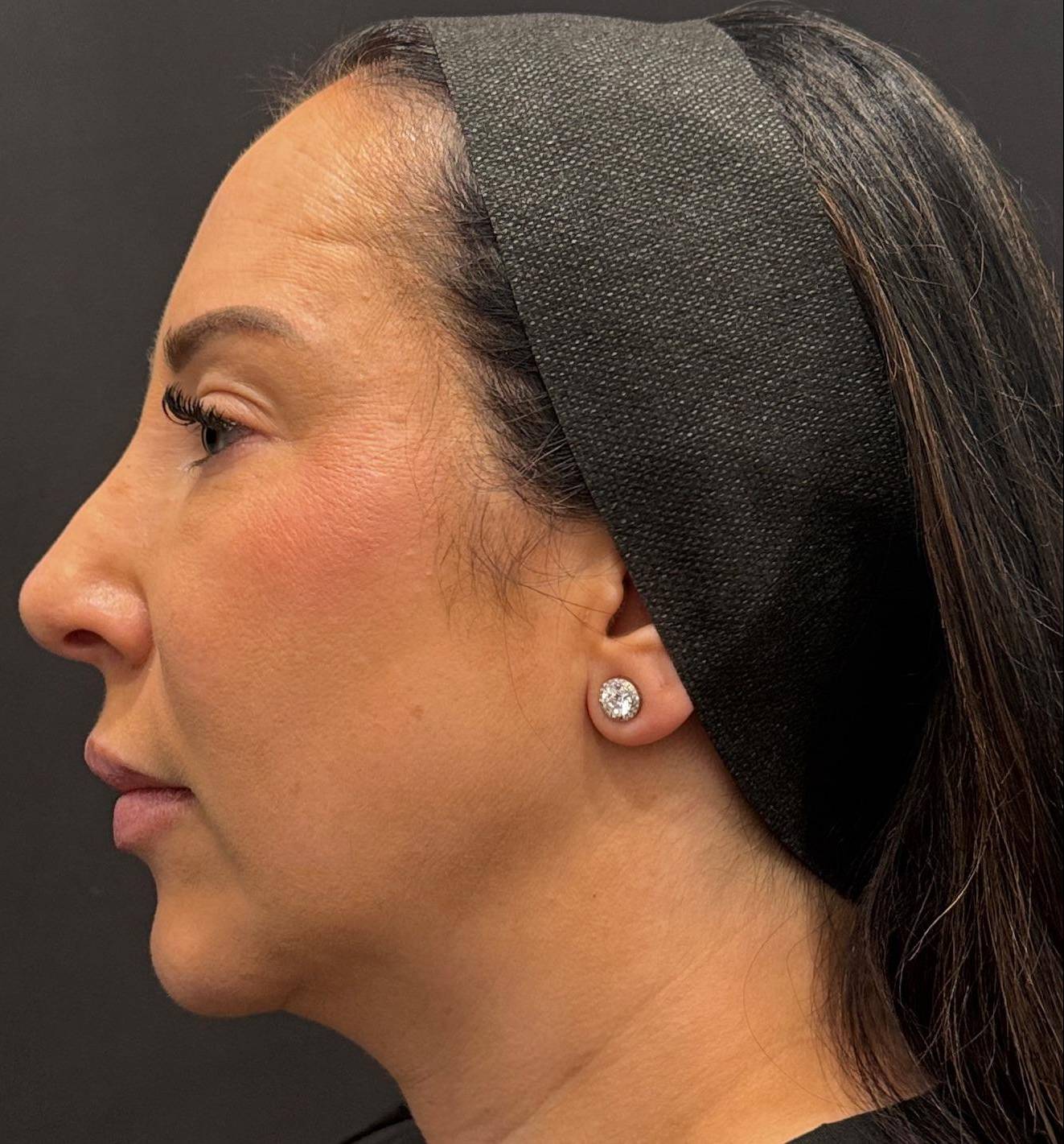 Before Radiesse treatment