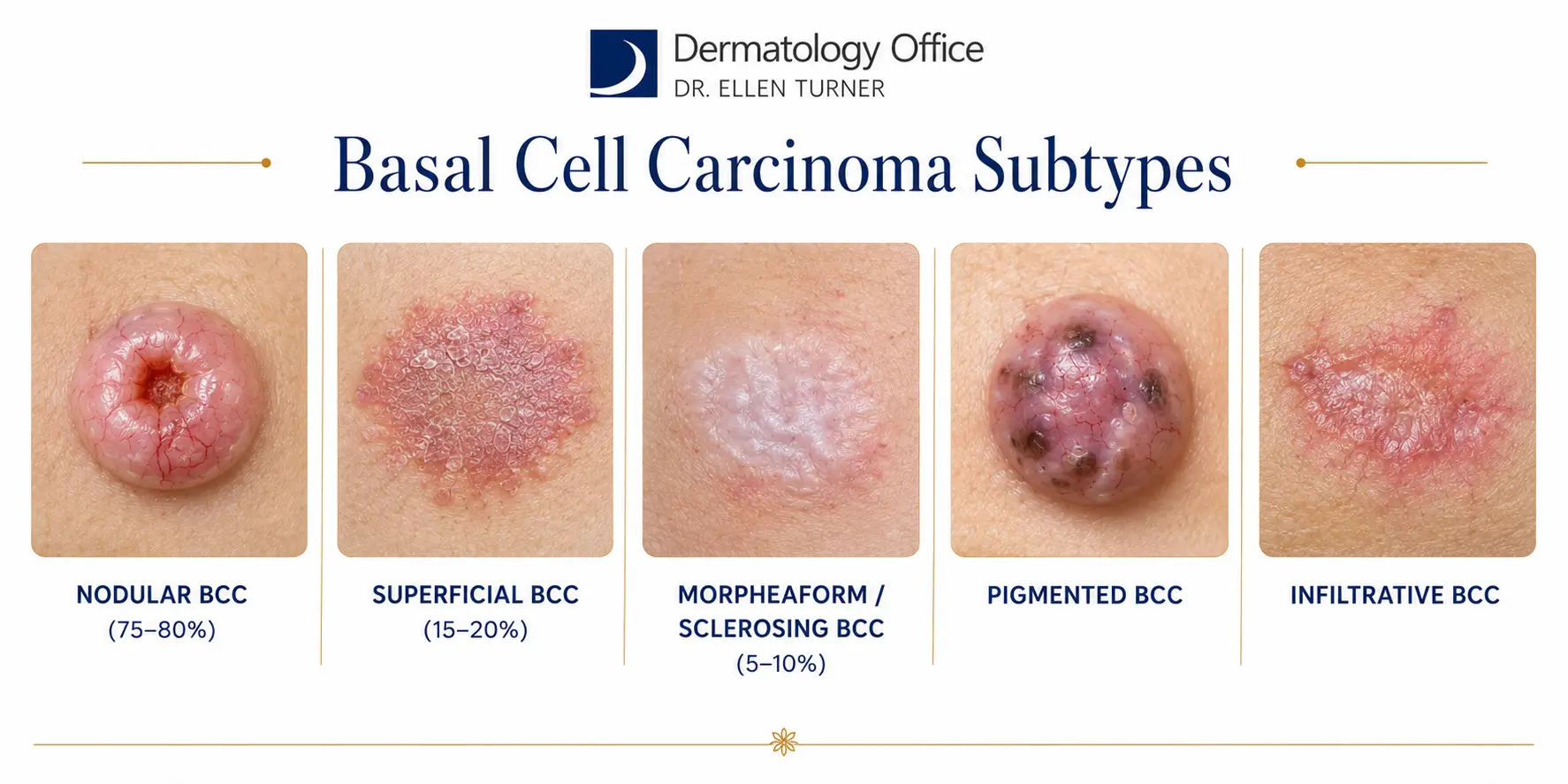 Five subtypes of basal cell carcinoma