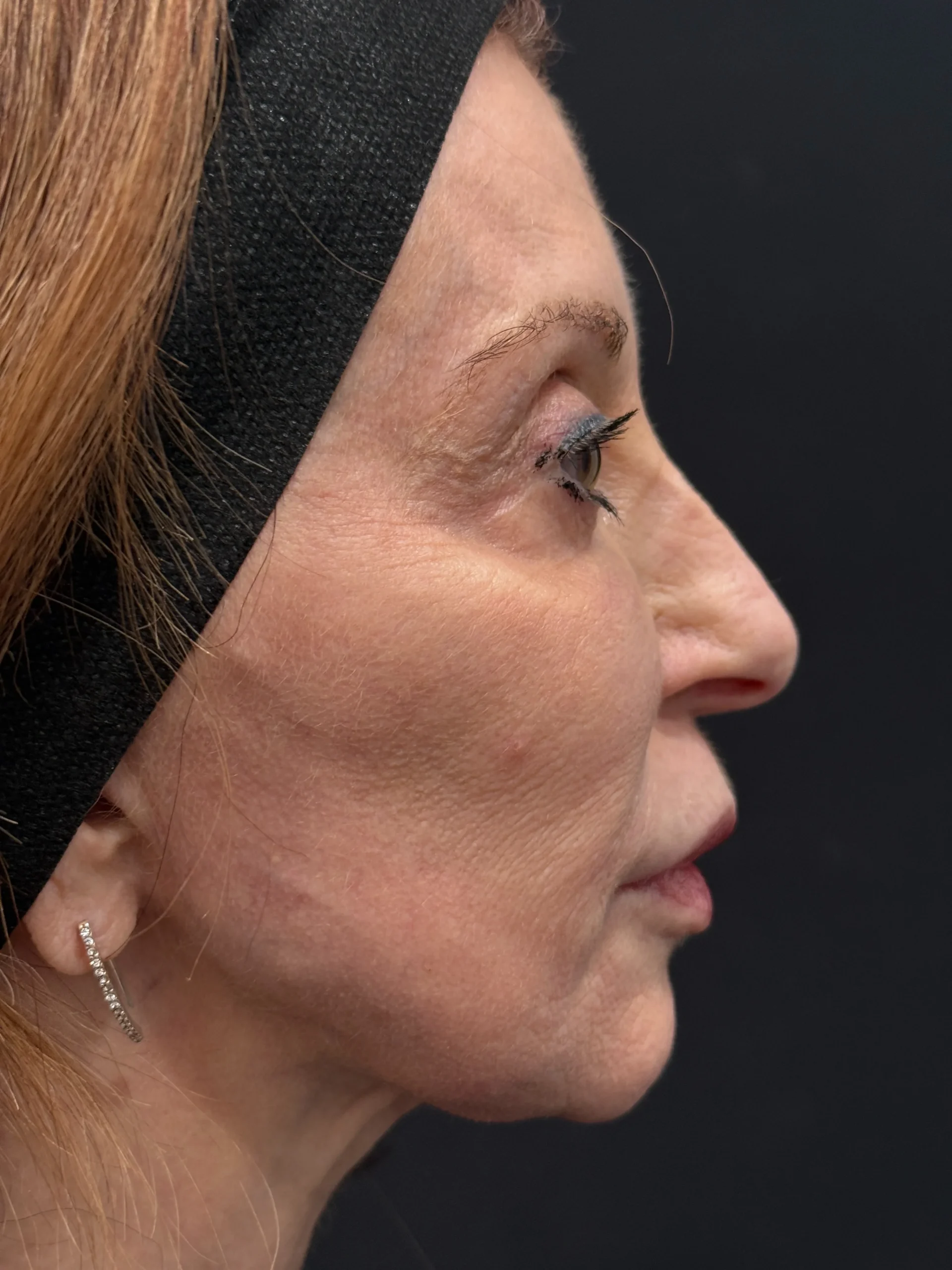BussoLyft cog thread facial lift after, Dr. Ellen Turner Irving patient