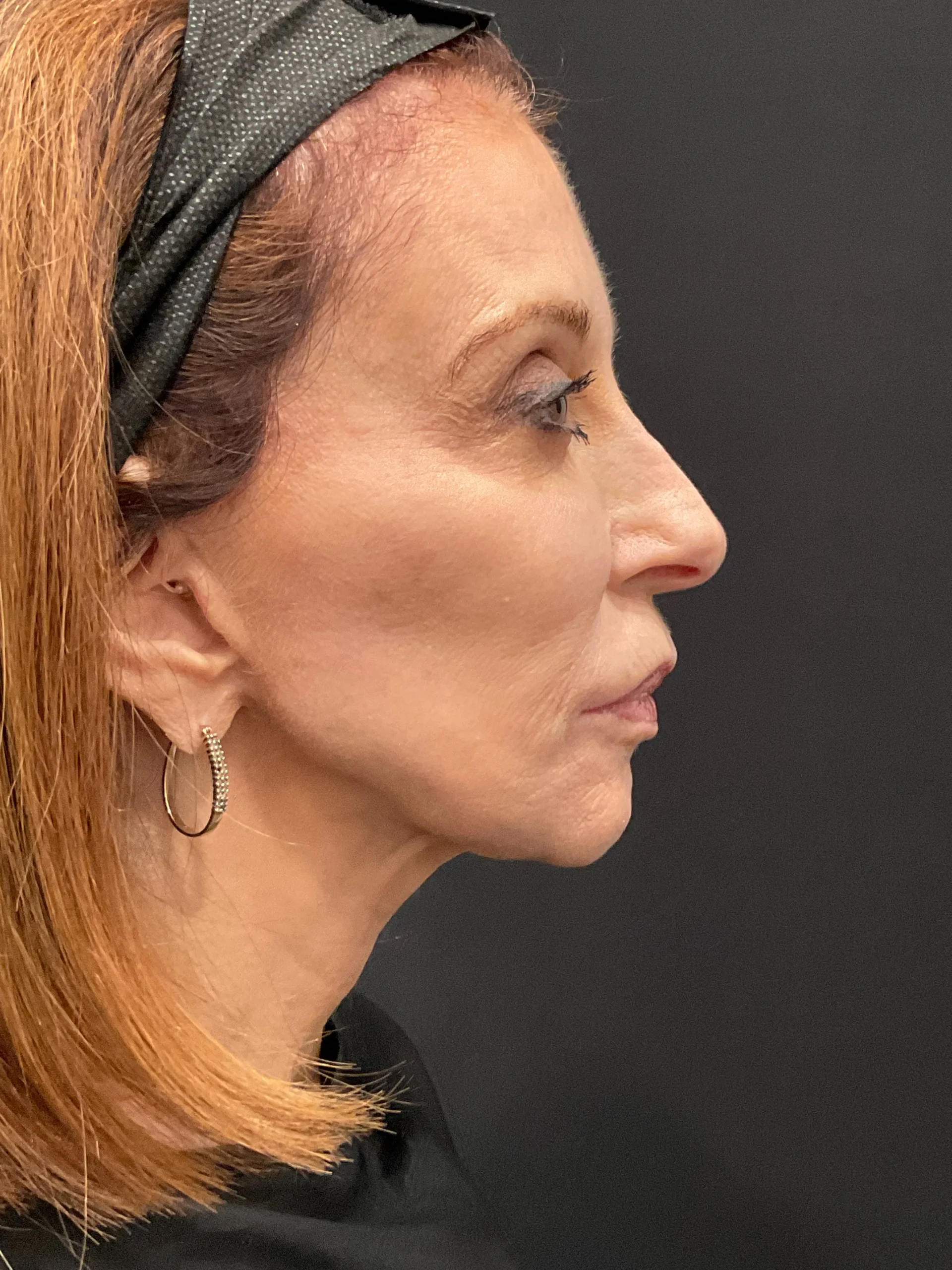 BussoLyft cog thread facial lift before, Dr. Ellen Turner Irving patient